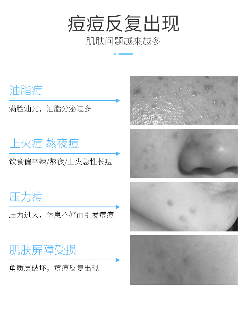 Chanrmshey Anti-Acne Cleansing Oil Control Box Freshing and Moistrurizing Oil Control Anti-Acne Moisturizing Skin Care Three-Piece Set Brightening Skin Color